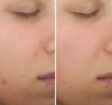 Signs Salicylic Acid Is Actually Working for You